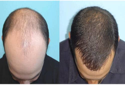 Safe, Low Cost Hair Transplants in Lima - Surgery in Peru