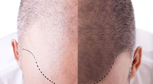 cuántos trasplantes de cabello se necesitan