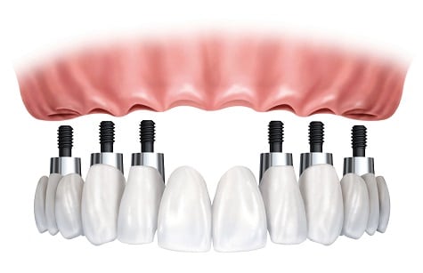 implantes dentals all on 4 y all on 6