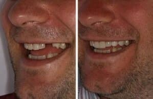 dental implants lima peru