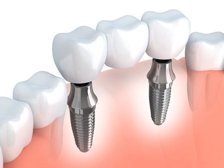 dental implant bridges