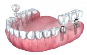 dental implants in peru