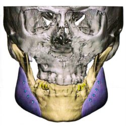 implantes-mandibular