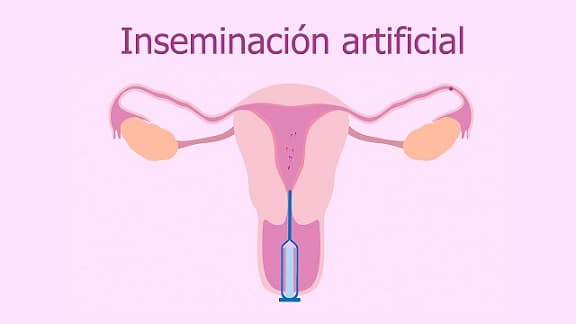 inseminacion-intrauterina