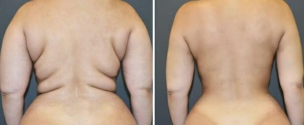 Back Lift Bra-Line Treatment - Plastic Surgery in Peru