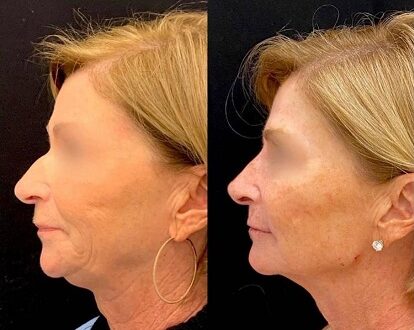 lifting facial y cuello
