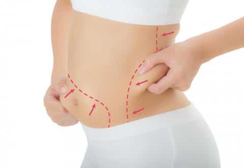 vasser liposuction