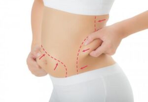 myths facts liposuction