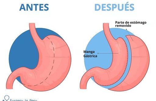 beneficios de la manga gastrica
