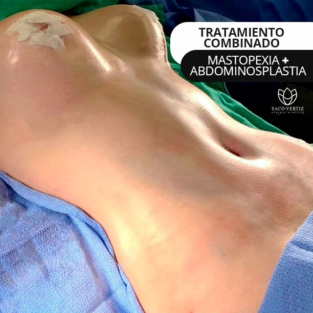 mastopexy abdominoplasty