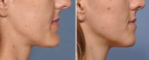 chin reduction surgery lima