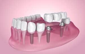 multiple dental implants
