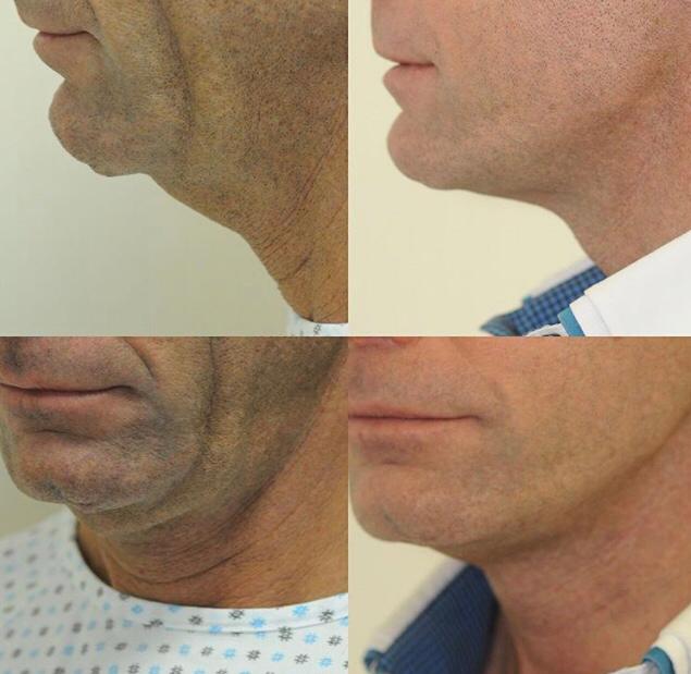 neck lift