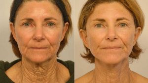 neck lift lima