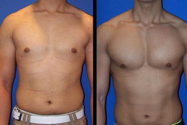 pectoral implants lima
