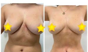 reduction mammoplasty
