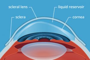 scleral lens