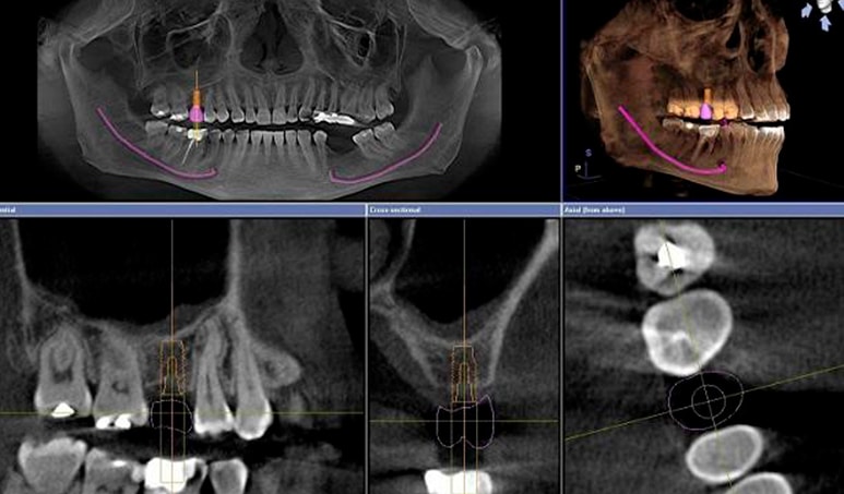 sinus lift