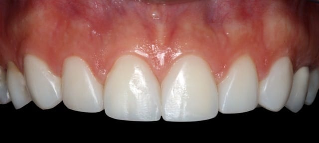 smile design veneers 2