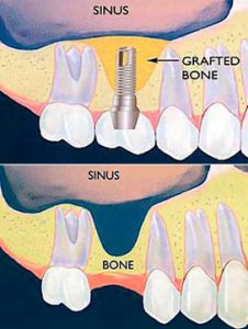 sinus lift bone graft, implant