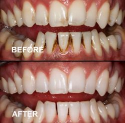 teeth-whitening-bannee2