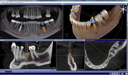 how long dental implants last